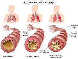 ASTHMA SYMPTOMS